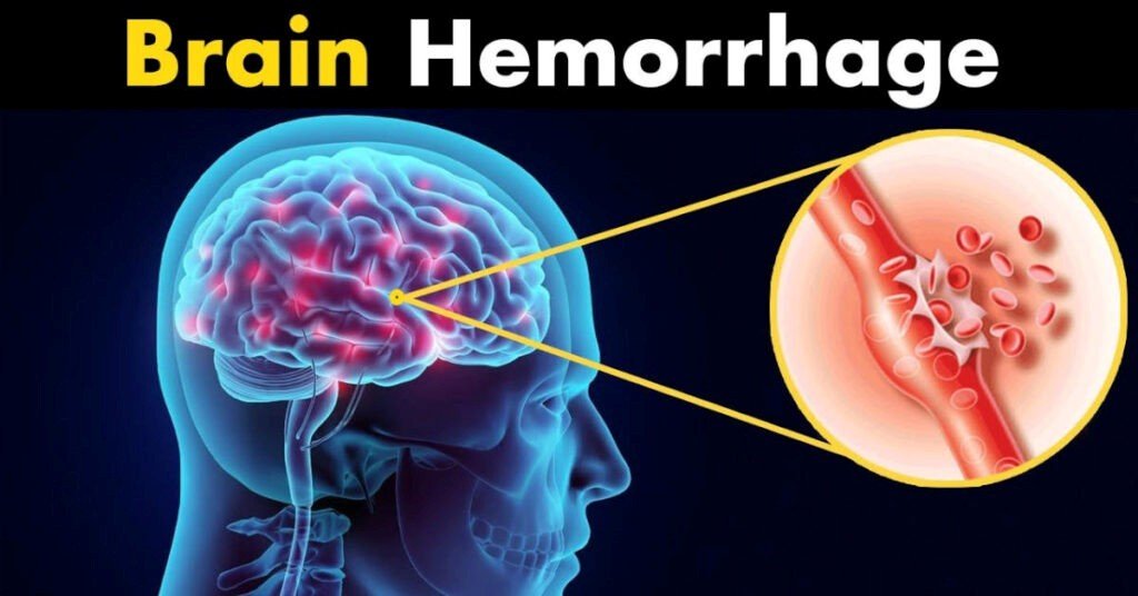 HOW I GOT CURED OF BRAIN HAEMORRHAGE AND THE SUBSEQUENT PARALYSIS – Part 1